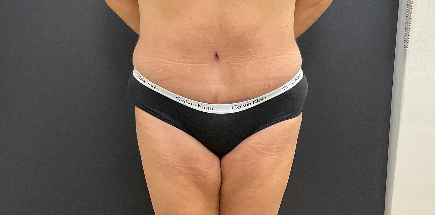 Post Weight Loss Before & After