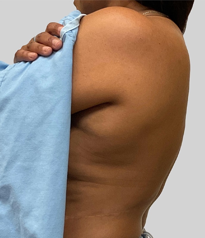 Post Weight Loss Before & After