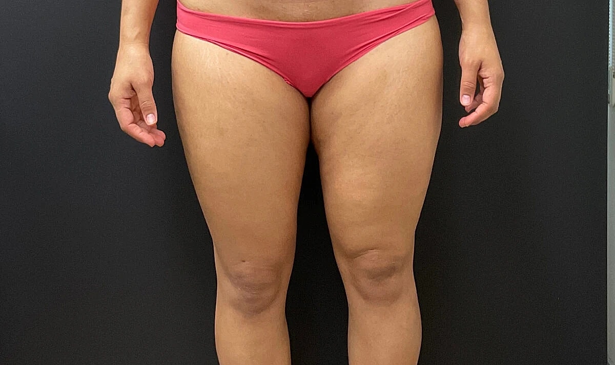 Post Weight Loss Before & After