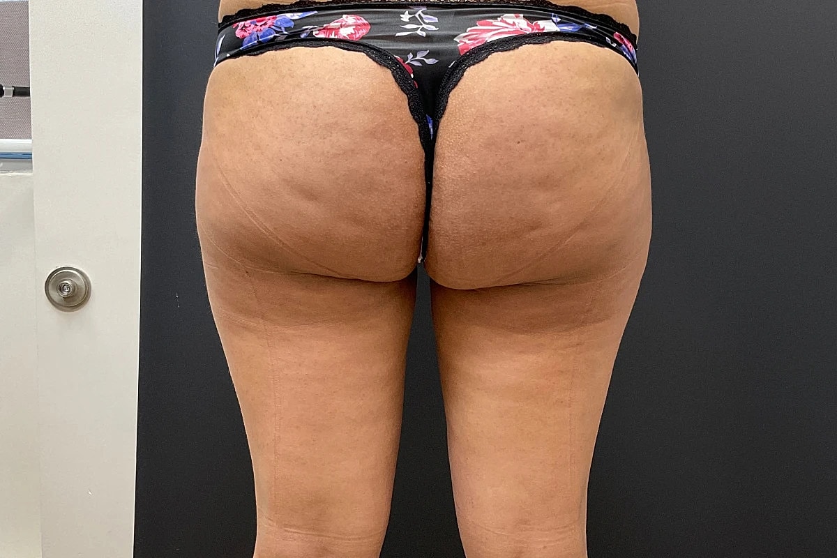 Post Weight Loss Before & After
