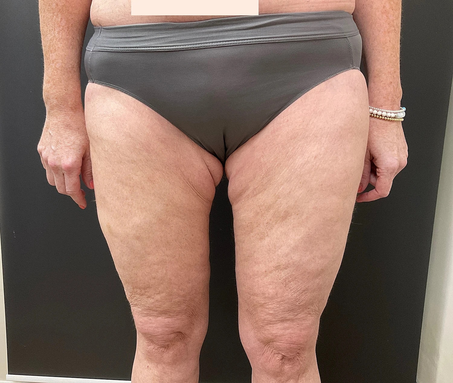 Post Weight Loss Before & After