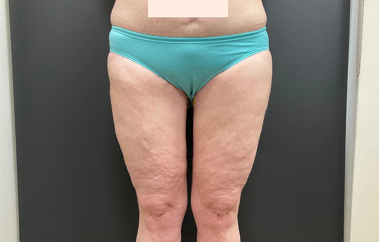 Post Weight Loss Before & After