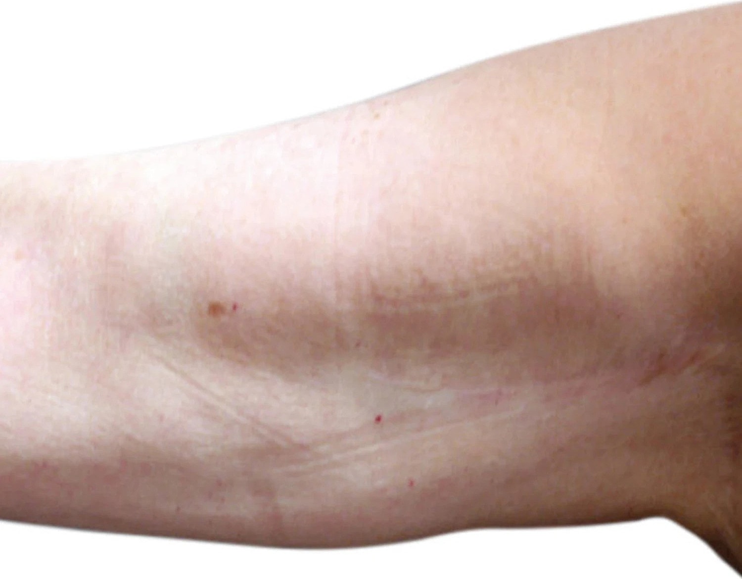 Skin Tightening Before & After