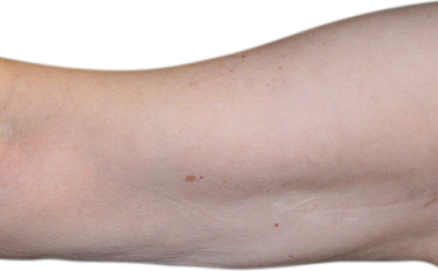 Skin Tightening Before & After