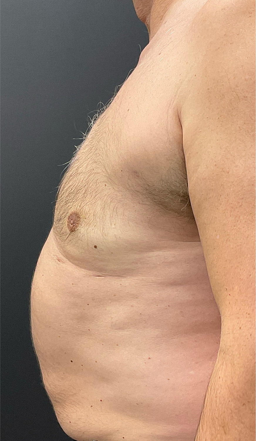 Gynecomastia Before & After