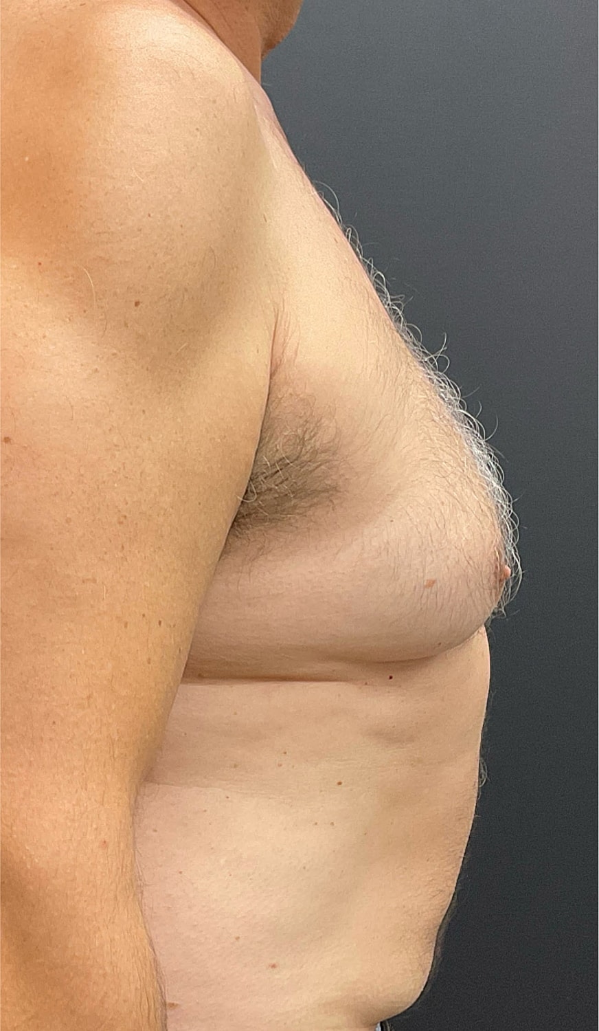 Gynecomastia Before & After