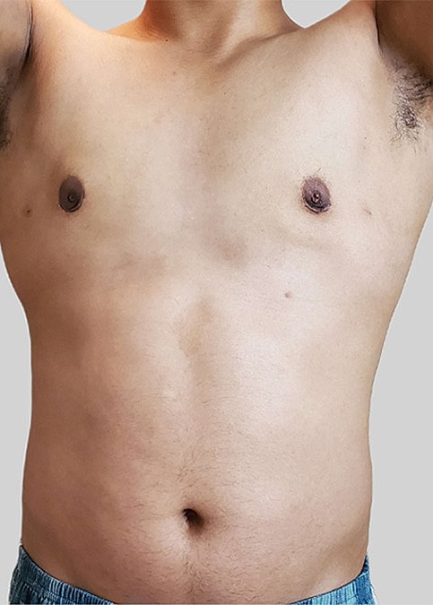 Gynecomastia Before & After