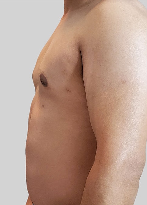 Gynecomastia Before & After