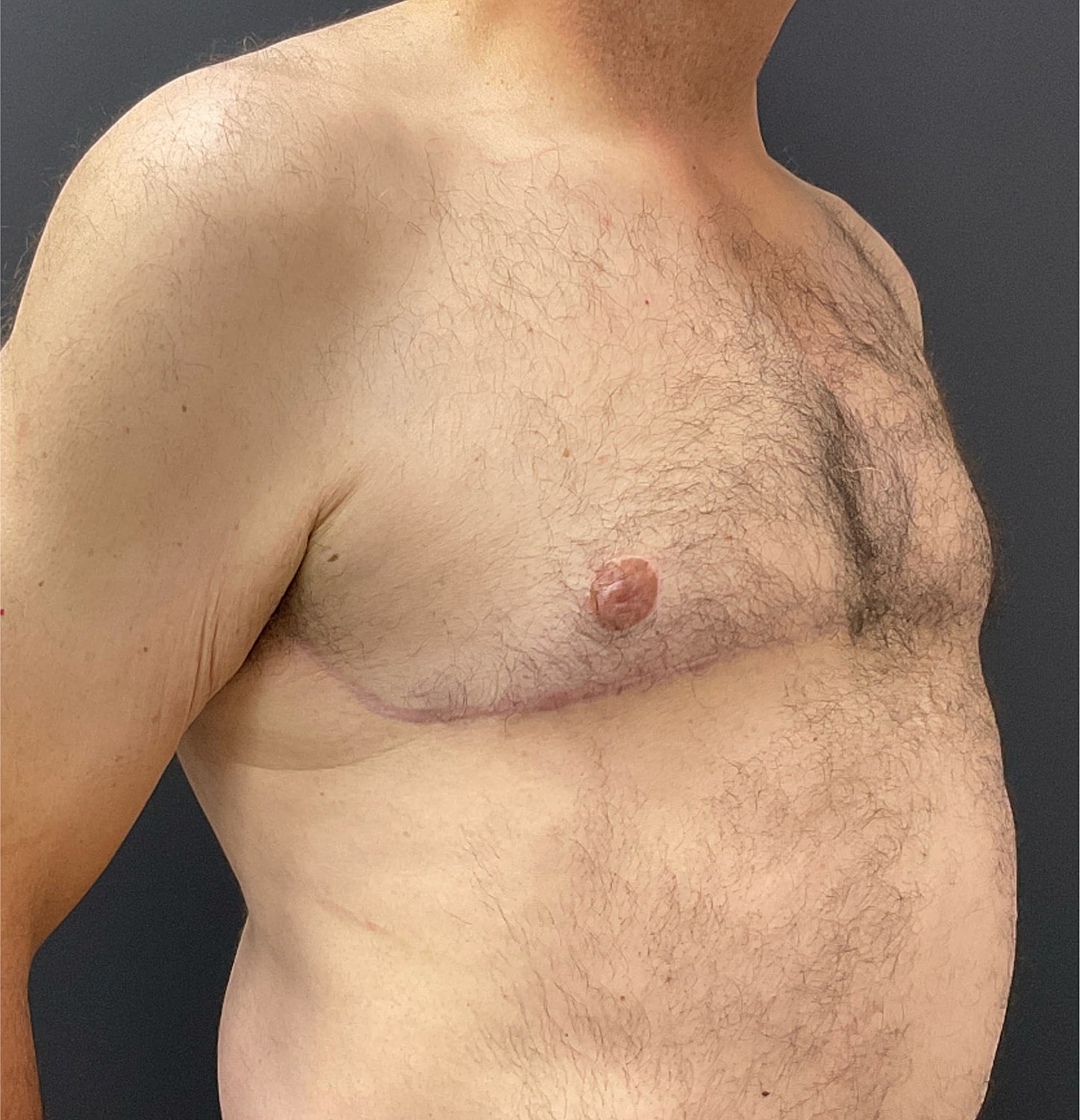 Gynecomastia Before & After