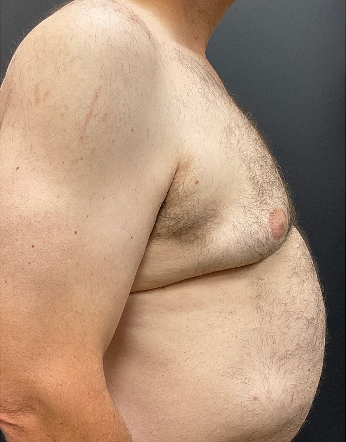 Gynecomastia Before & After