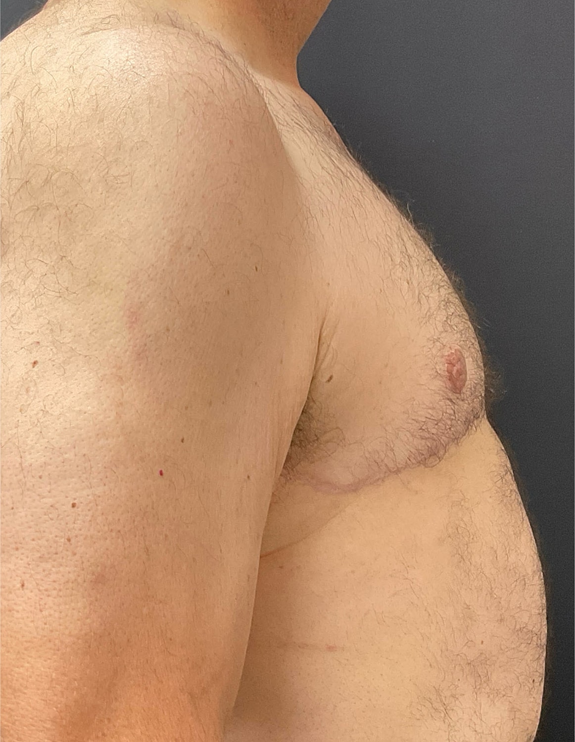 Gynecomastia Before & After