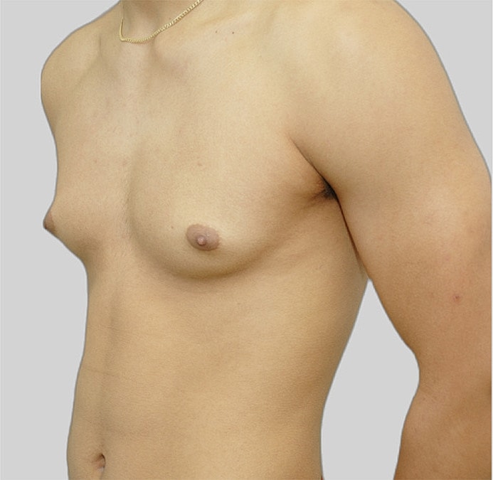 Gynecomastia Before & After