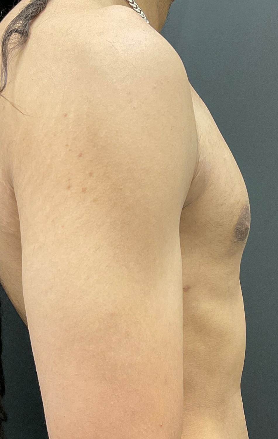 Gynecomastia Before & After