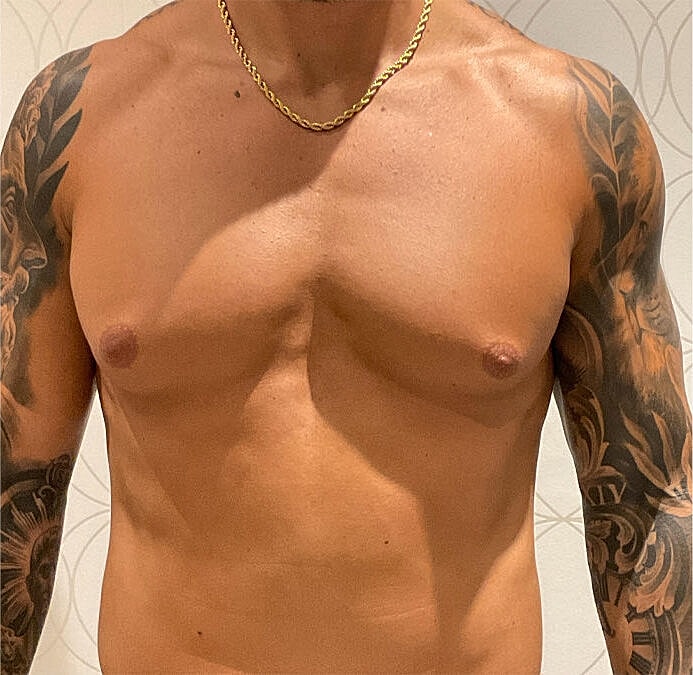 Gynecomastia Before & After