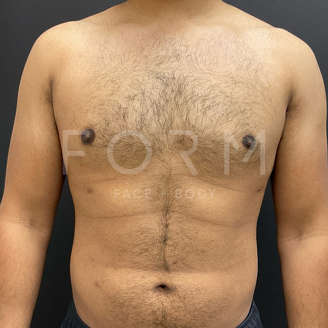 Gynecomastia Before & After