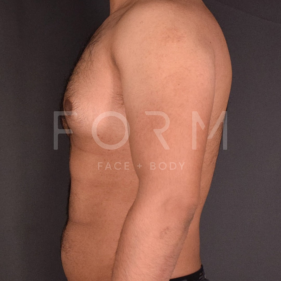 Gynecomastia Before & After