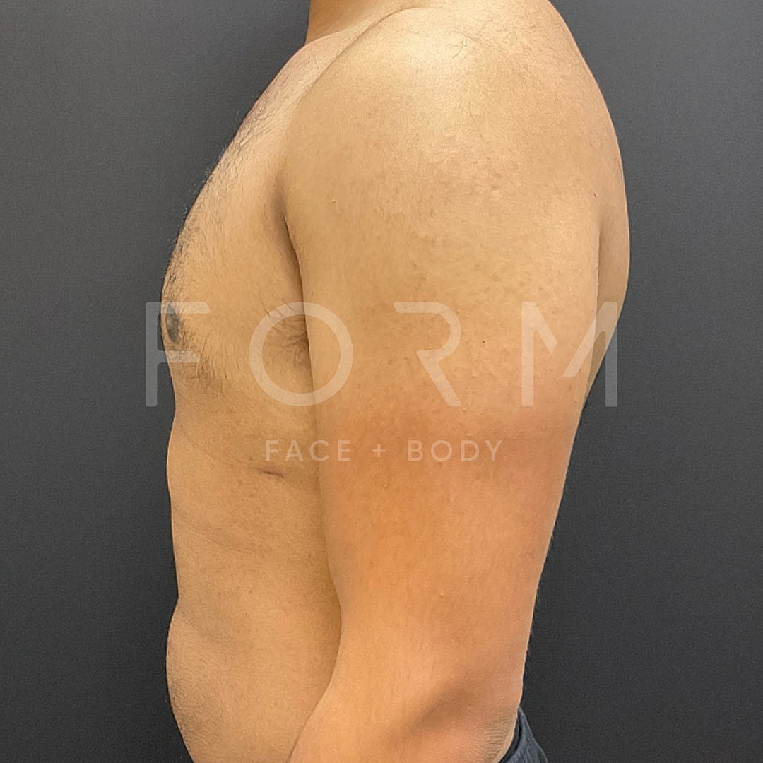 Gynecomastia Before & After