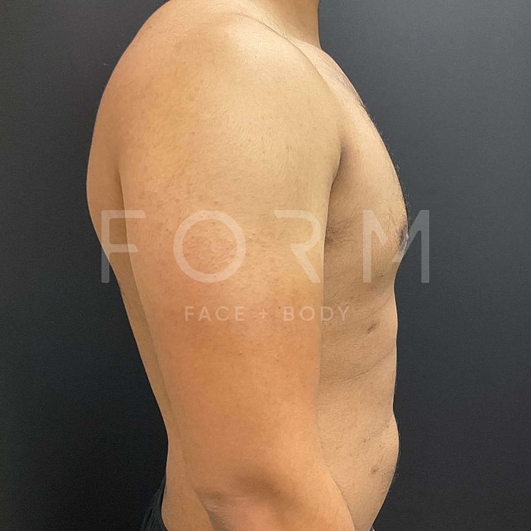 Gynecomastia Before & After