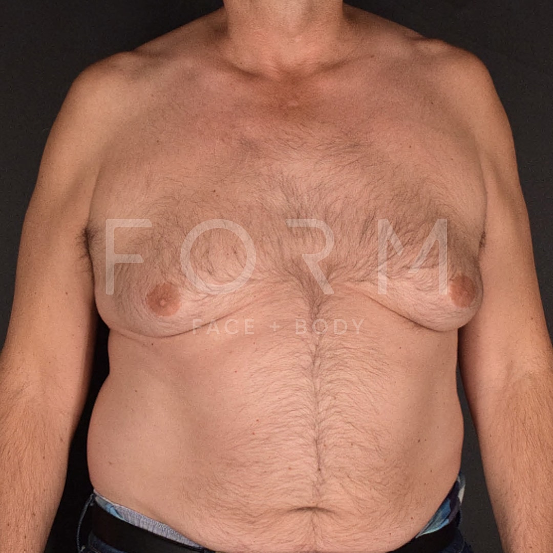 Gynecomastia Before & After