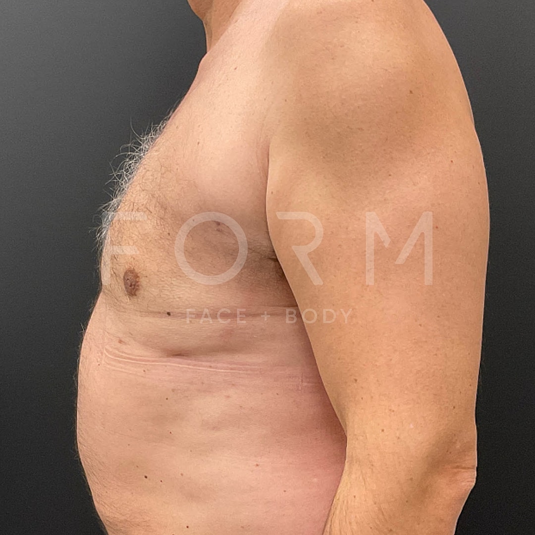 Gynecomastia Before & After