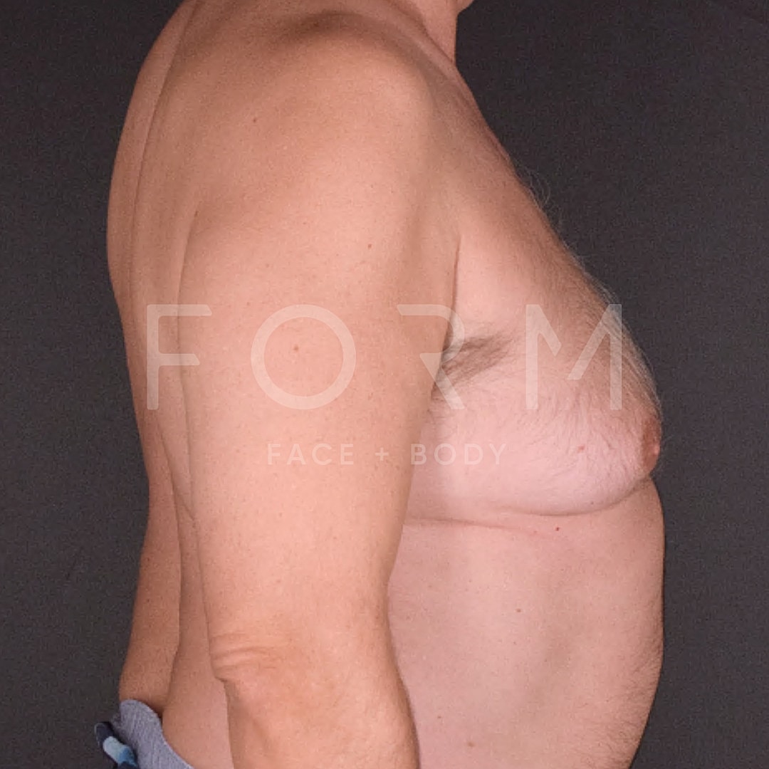 Gynecomastia Before & After