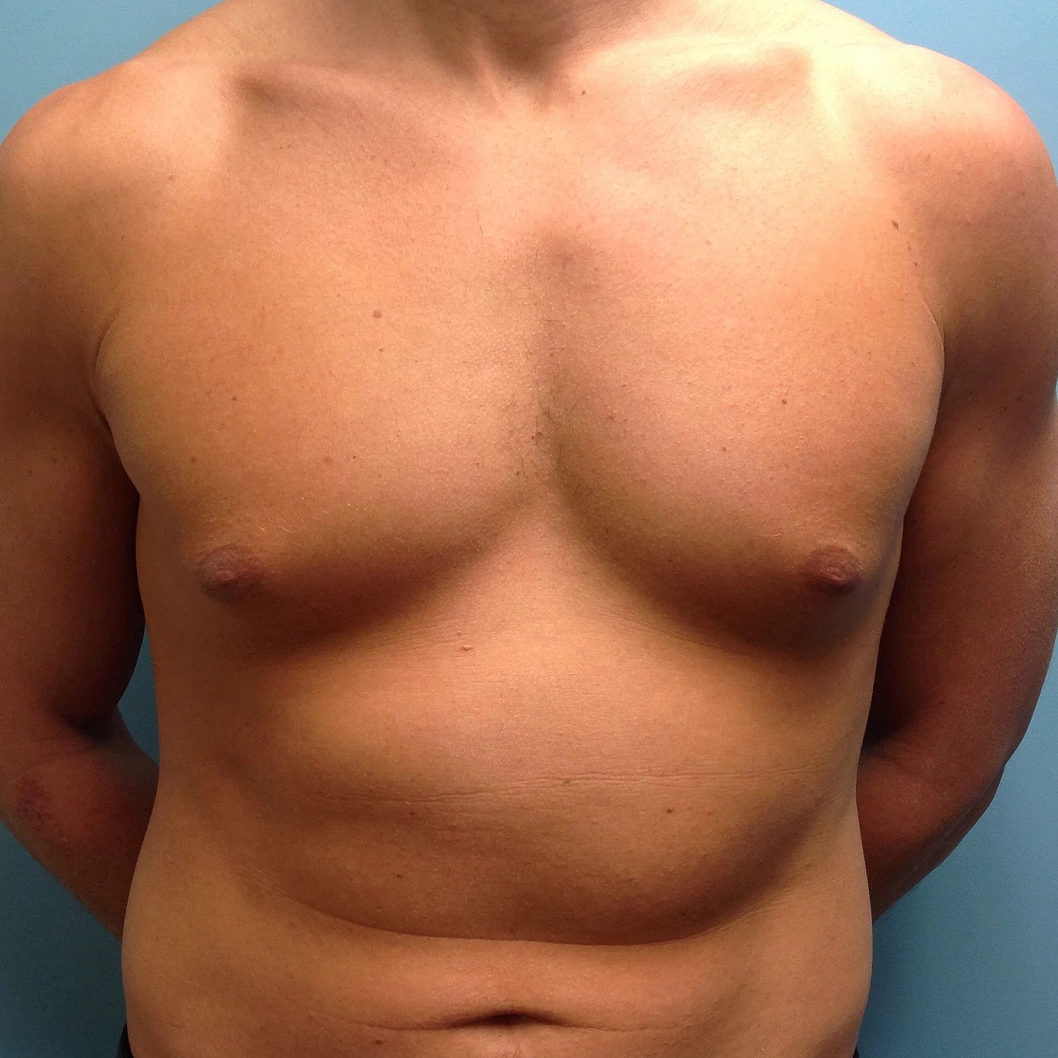 Gynecomastia Before & After