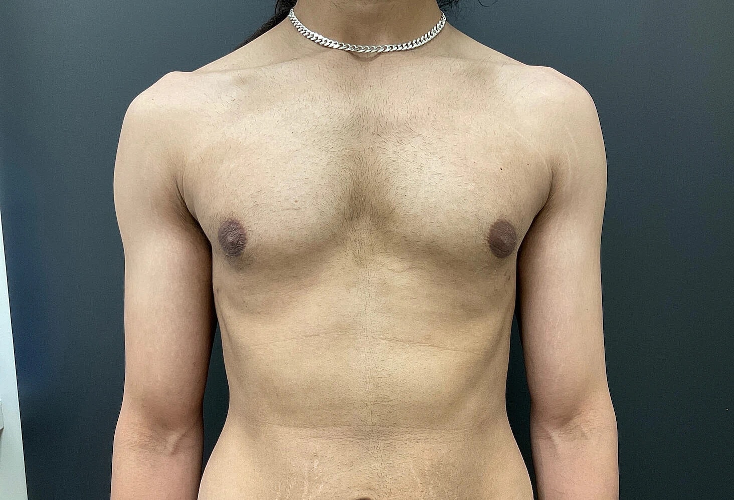 Gynecomastia Before & After