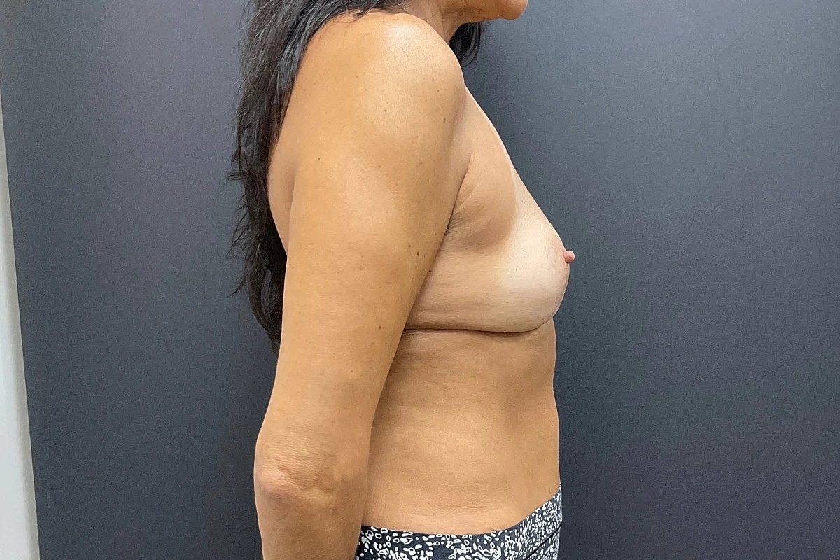 Breast Revision Before & After