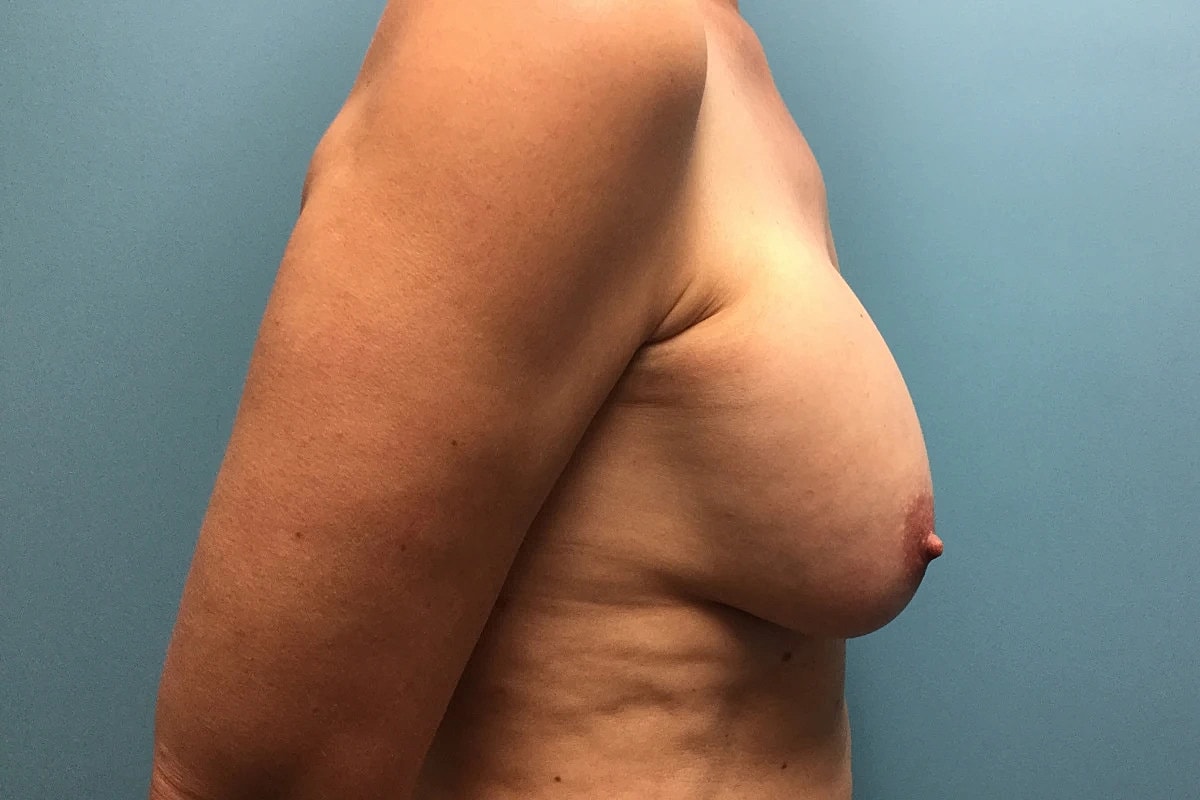 Breast Revision Before & After