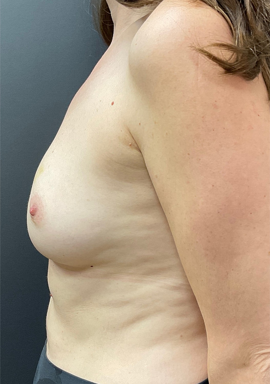 Breast Reconstruction Before & After