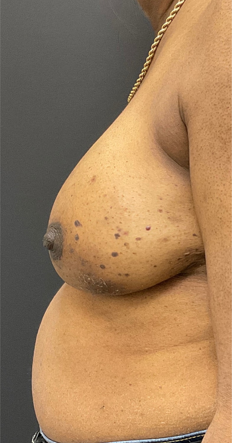 Breast Reconstruction Before & After
