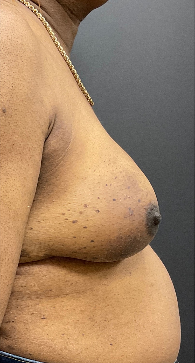 Breast Reconstruction Before & After