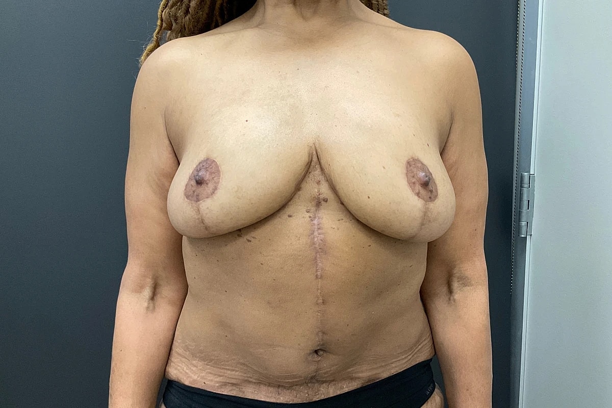 Breast Lift Before & After