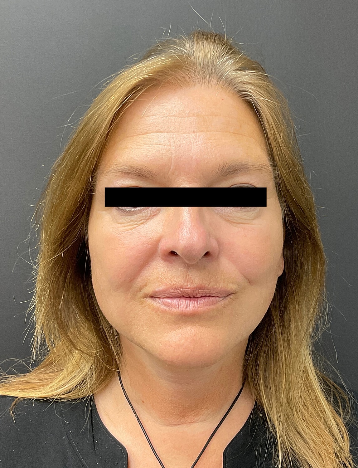 Neuromodulators Before & After