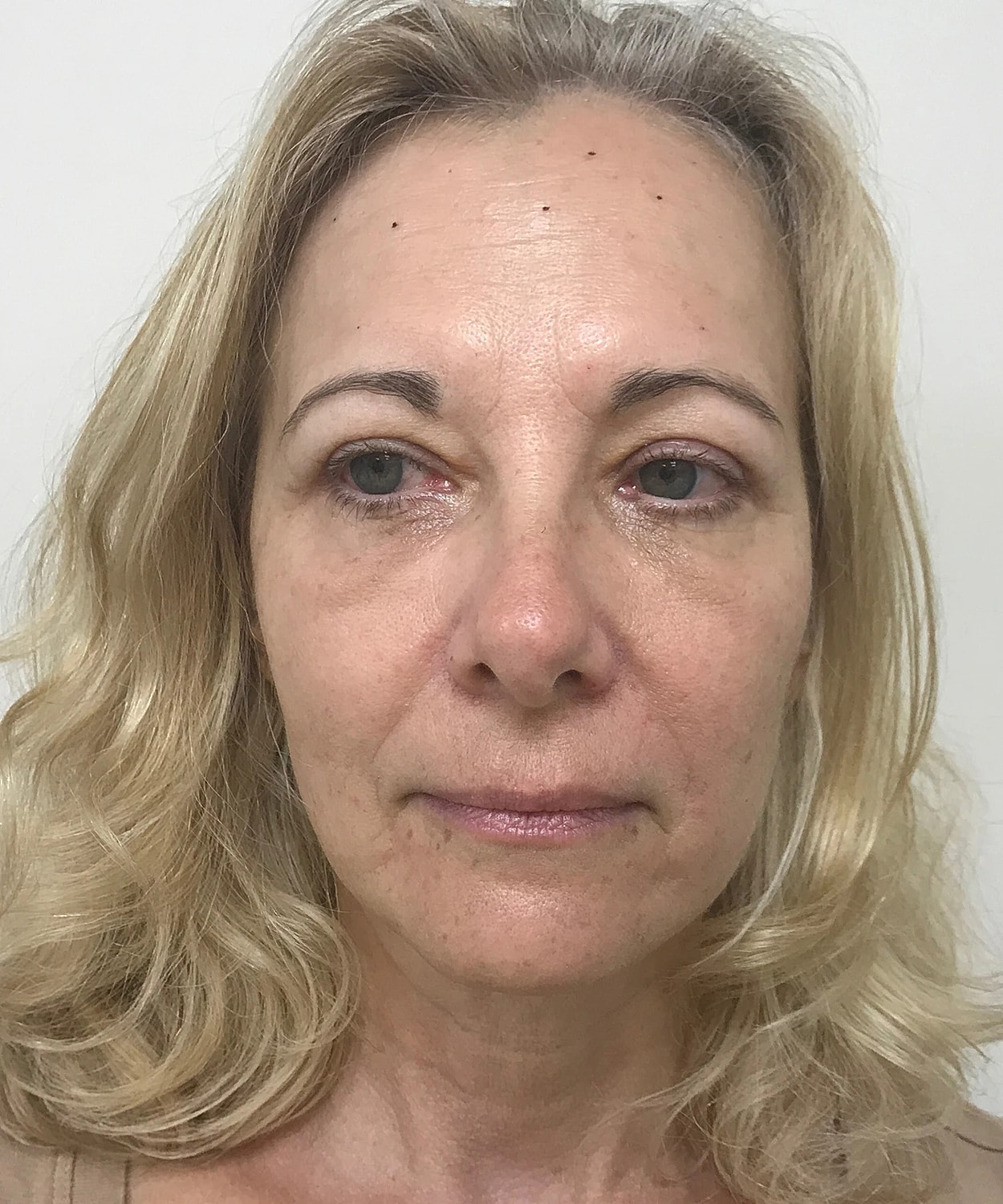 Neuromodulators Before & After