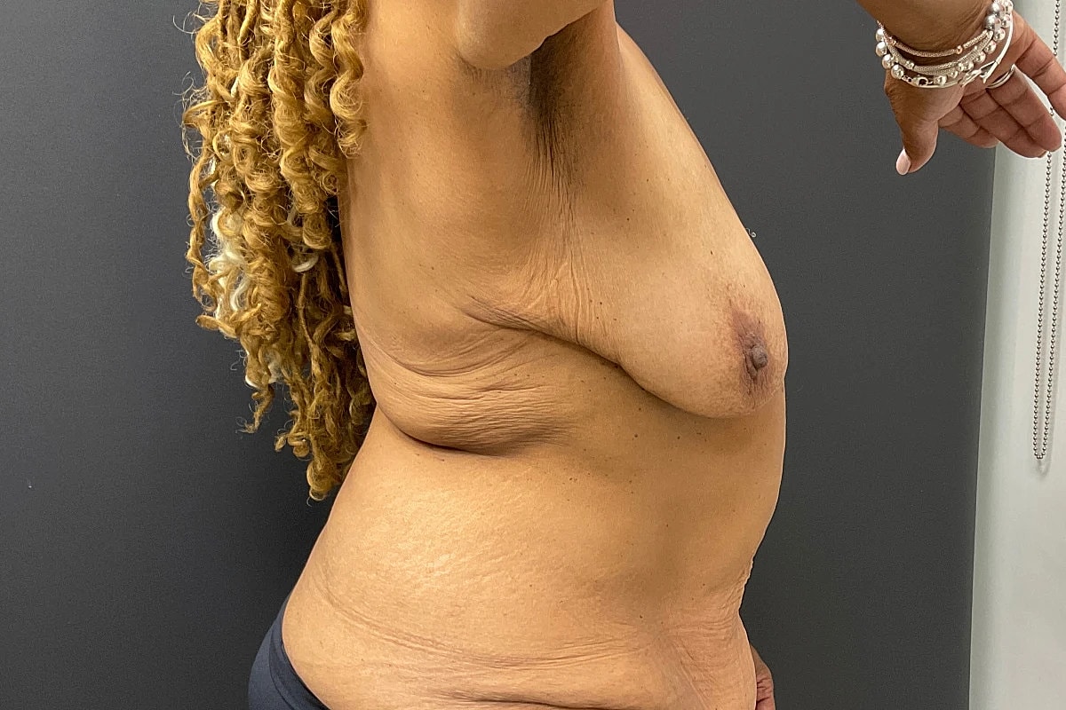 Mastopexy Before & After