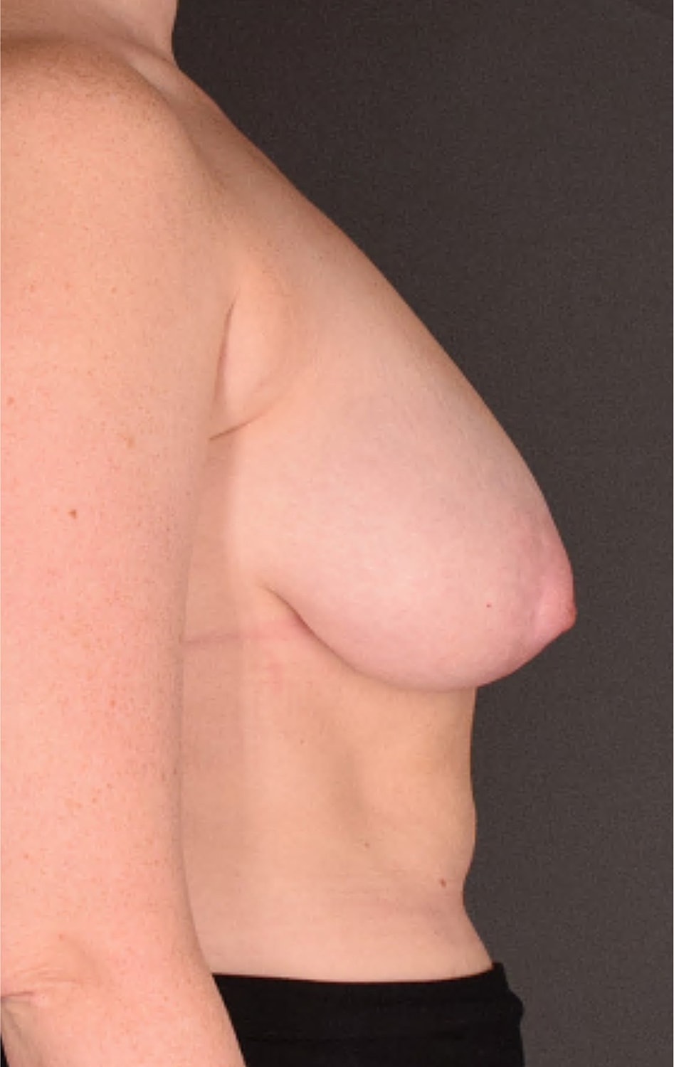Mastopexy Before & After