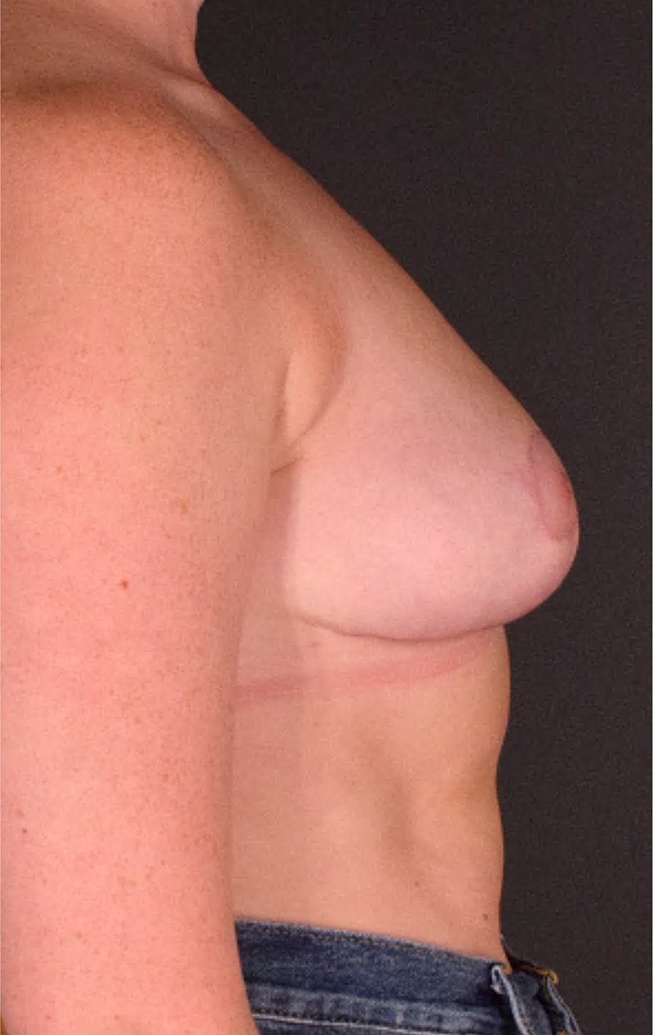 Mastopexy Before & After
