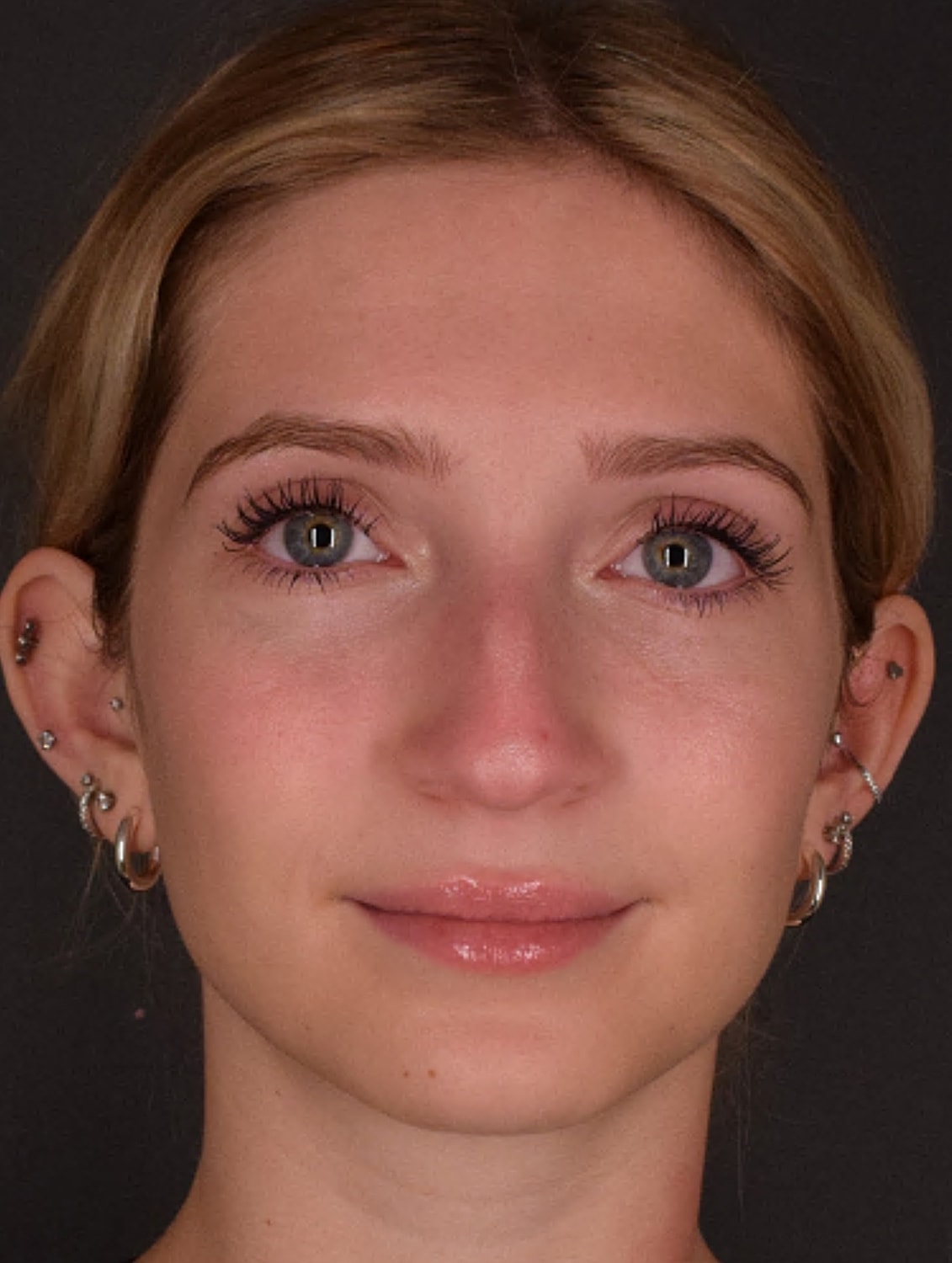 Rhinoplasty Before & After