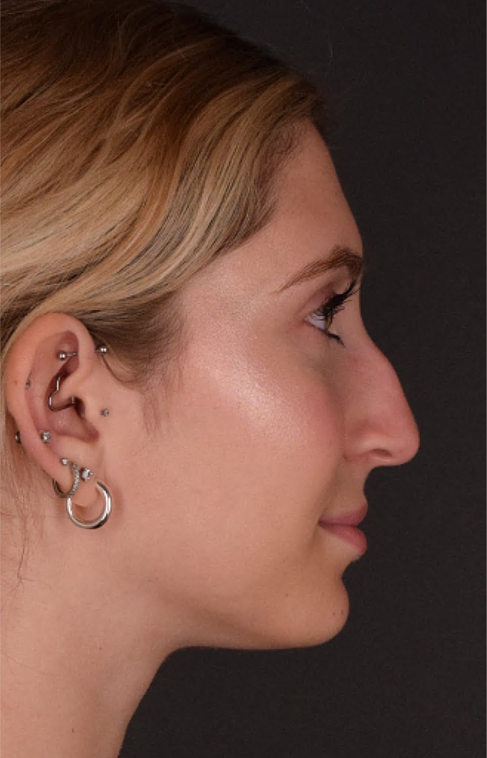 Rhinoplasty Before & After