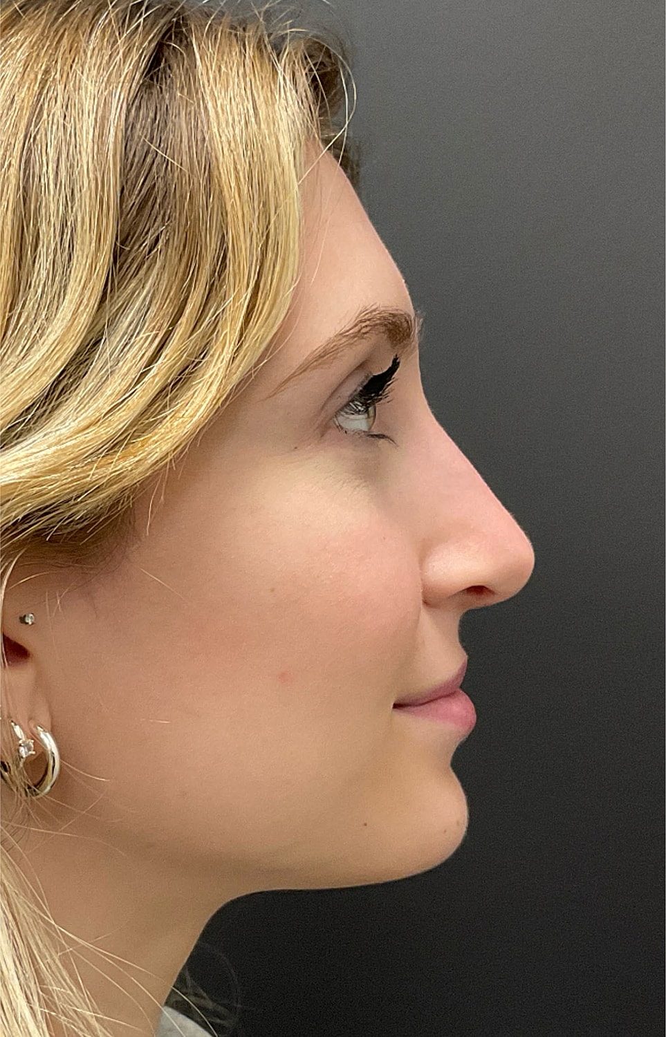 Rhinoplasty Before & After