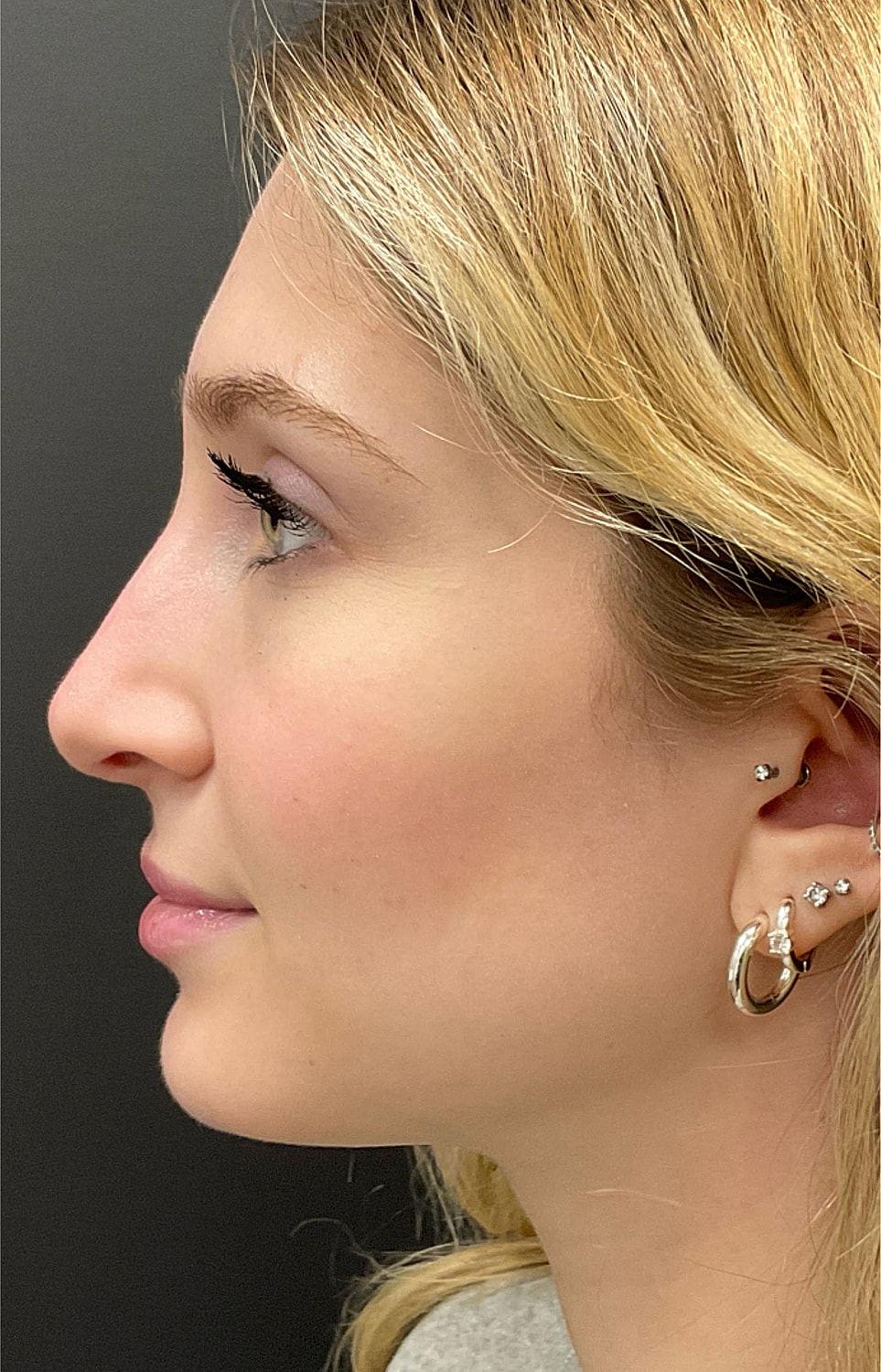 Rhinoplasty Before & After