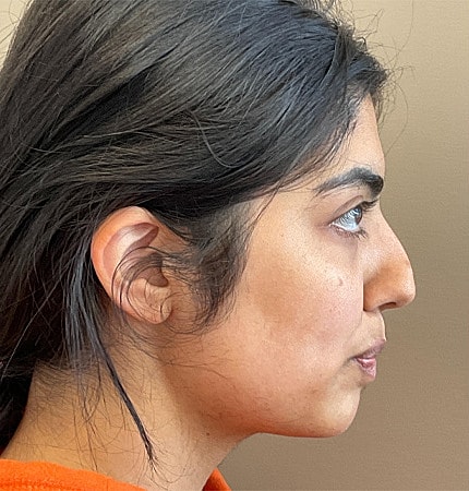 Rhinoplasty Before & After