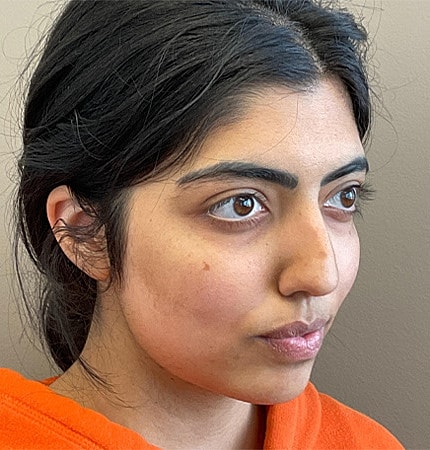Rhinoplasty Before & After