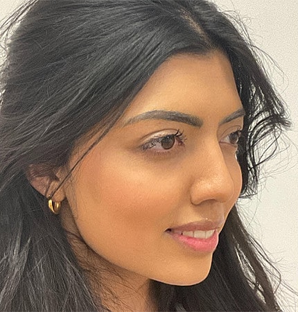 Rhinoplasty Before & After