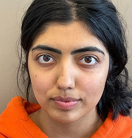 Rhinoplasty Before & After