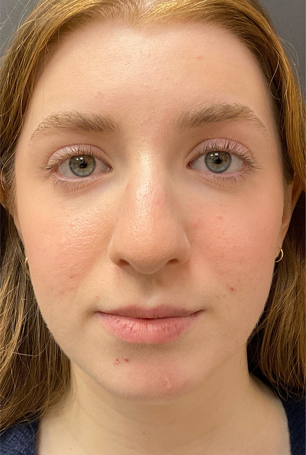 Rhinoplasty Before & After