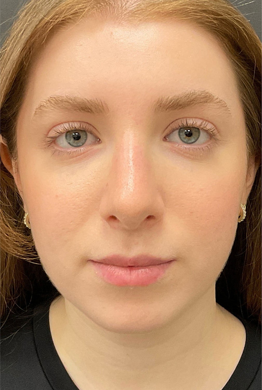 Rhinoplasty Before & After