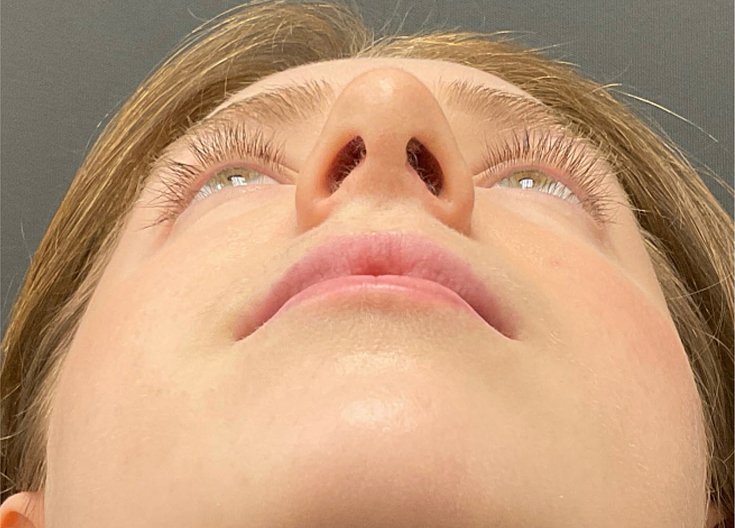 Rhinoplasty Before & After