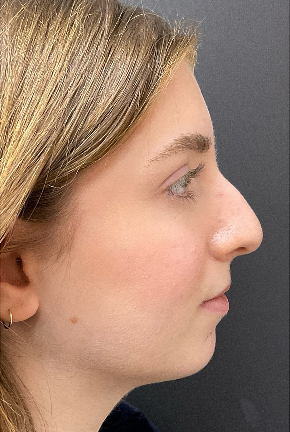Rhinoplasty Before & After
